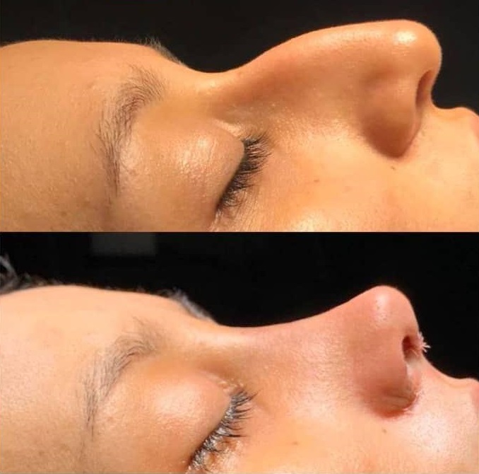 عکس عمل بینی استخوانی طبیعی