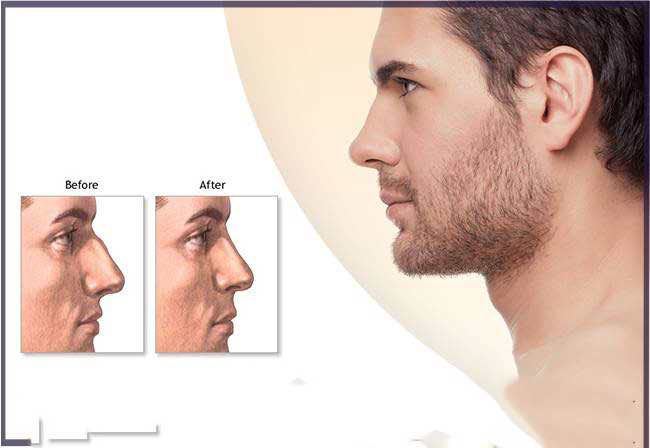 جراحی بینی مردانه - عمل زیبایی بینی مردانه طبیعی در تهران 1 جراحی بینی مردانه