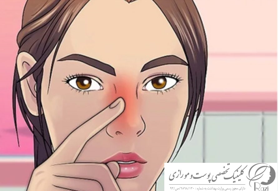 ورم بینی بعد از عمل و درمان ورم بینی گوشتی و یکطرفه 1 ورم بینی بعد از عمل