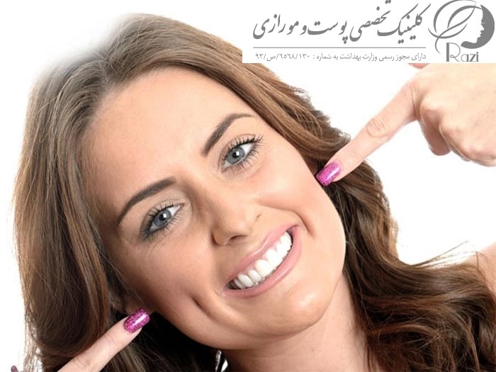 ایجاد چال گونه در خانه با درب بطری