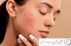 علت جوش زدن صورت