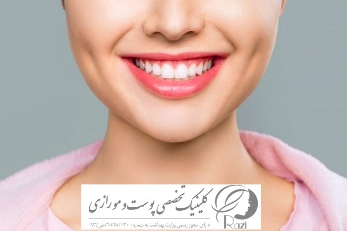 ایجاد چال گونه در خانه با ارایش