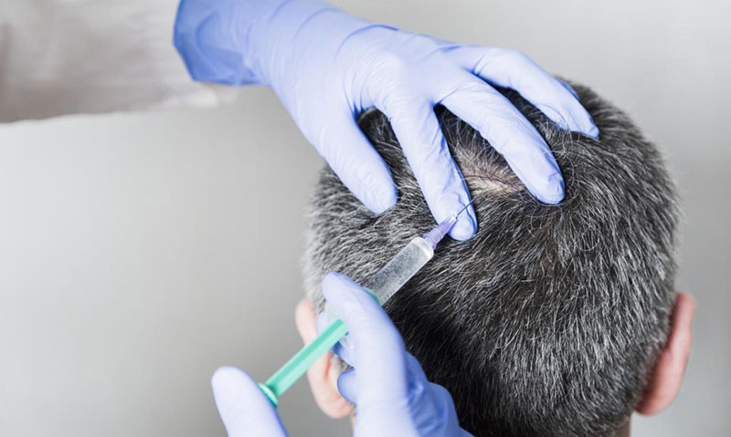 هزینه کاشت مو به روش SUT + مزایا، معایب و مراحل روش sut 2 مراحل کاشت مو به روش SUT