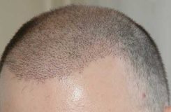 کاشت مو به روش fit