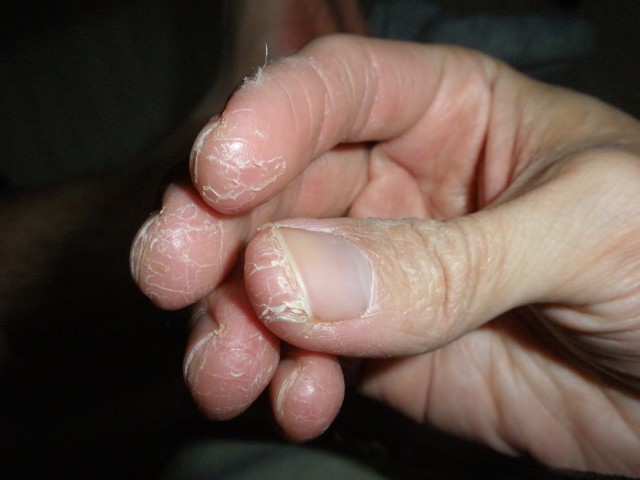 پوست پوست شدن انگشتان دست با مصرف مواد شیمیایی