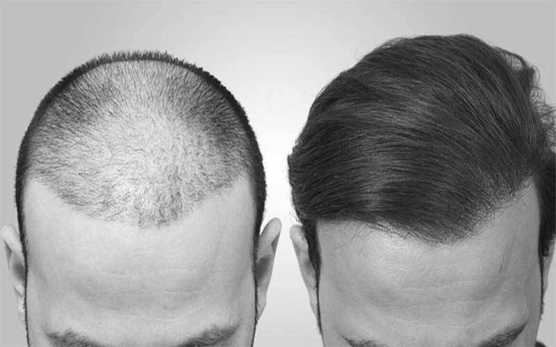 درصد موفقیت کاشت مو به روش سلولهای بنیادی