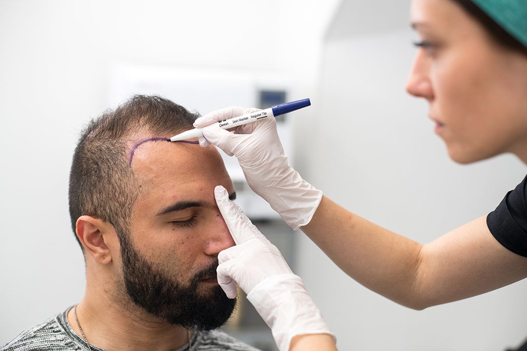 کاشت مو از ریش به سر در تهران + هزینه، مزایا و معایب آن 2 مزایای کاشت مو از ریش