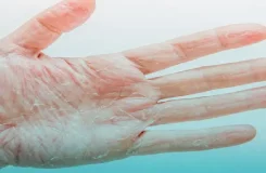 پوسته شدن دست