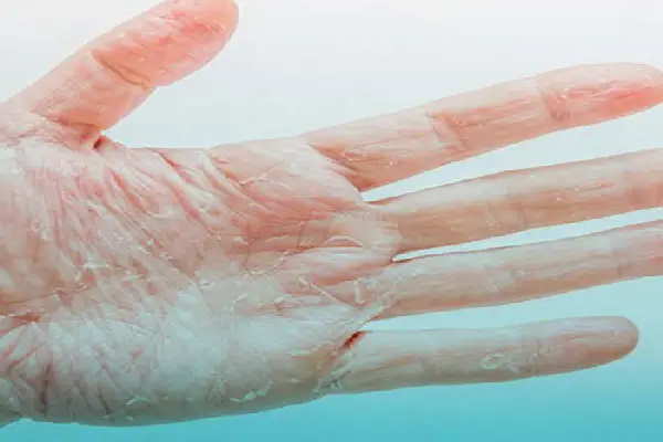 پوسته شدن دست