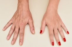 جوانسازی پوست دست