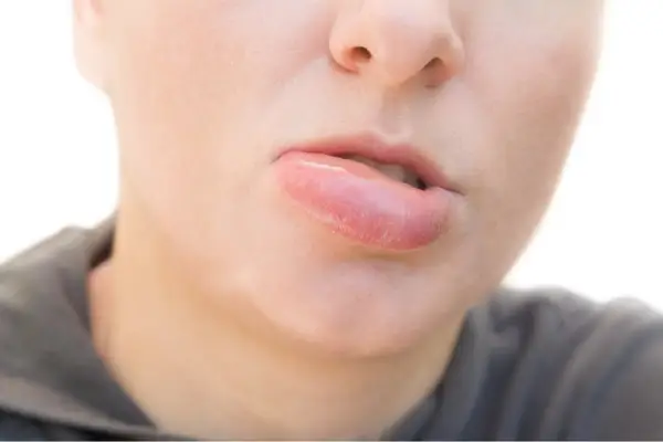 درمان تورم لب با آبسه دهان