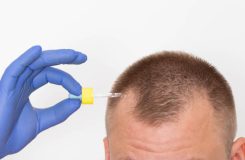 Taking minoxidil after hair transplant
