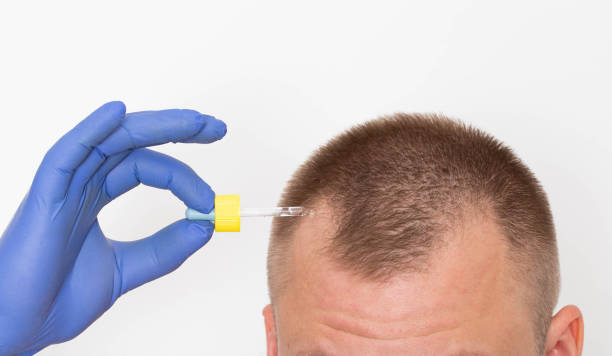 Finasteride after hair transplant