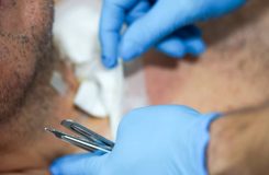 آیا کاشت مو برای افراد دیابتی ضرر دارد