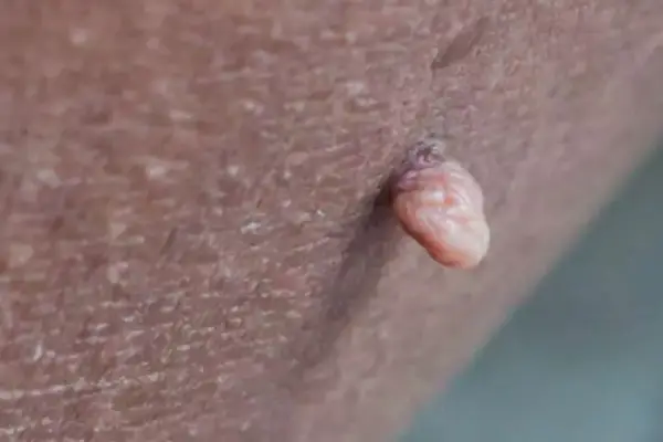 راهنمایی جامع در مورد زگیل تناسلی مردان+ معرفی جدیدترین داروهای درمانی 2 زگیل تناسلی