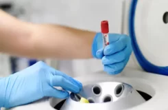 درمان زگیل با لیزر