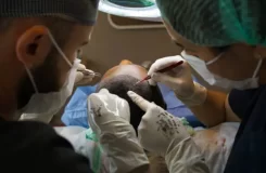 Hair transplantation