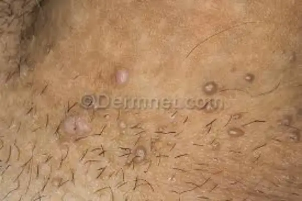 آیا احتمال ابتلا به زگیل تناسلی با یک بار رابطه جنسی 1 زگیل تناسلی