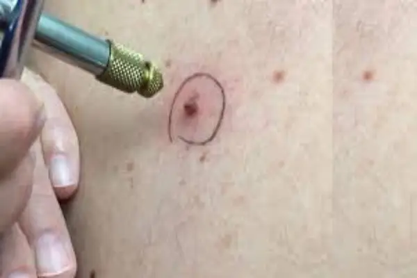 پلاسما برای زگیل تناسلی چه نتیجه ای دارد؟ 3 زگیل تناسلی